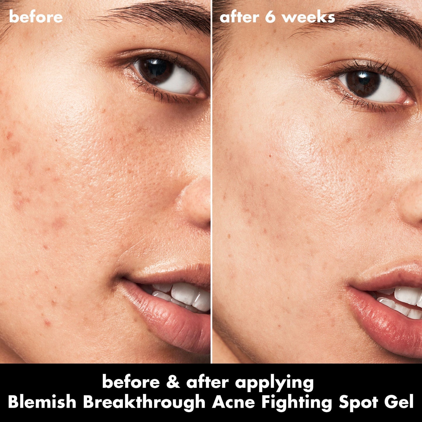 blemish-breakthrough-acne-fighting-spot-gel-b0 0326_EDU_BB_SpotGel_BA_ISABELLA.jpg