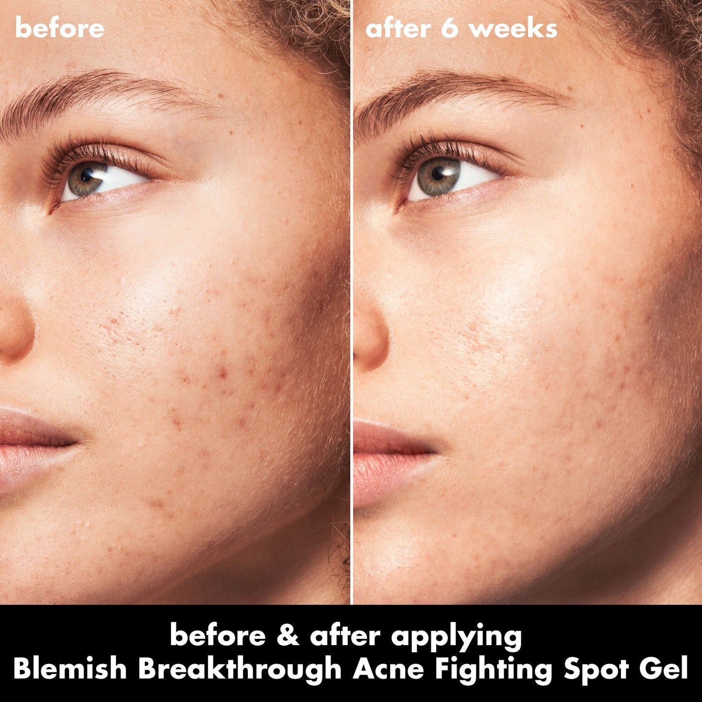 blemish-breakthrough-acne-fighting-spot-gel-b0 0326_EDU_BB_SpotGel_BA_MARLEY.jpg