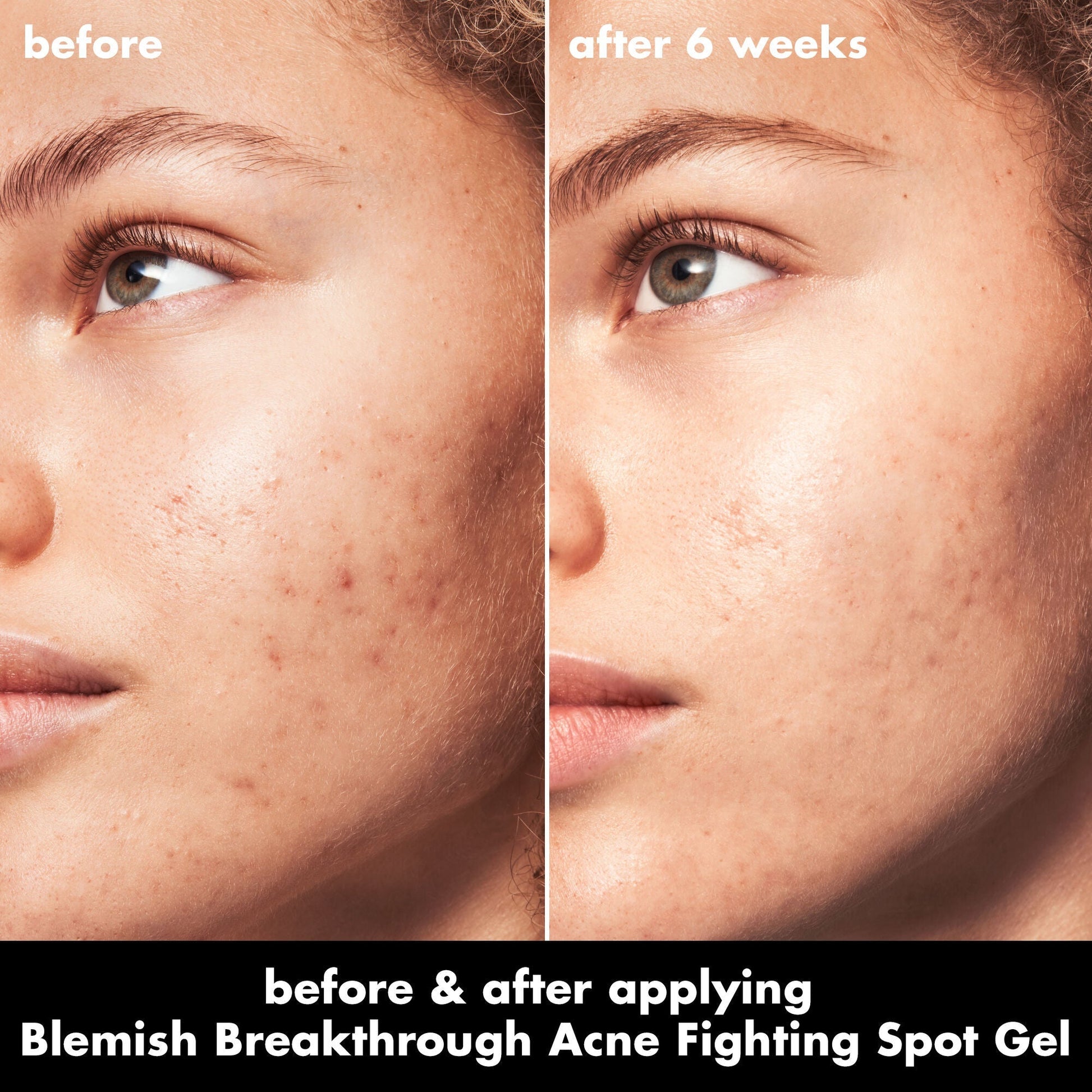 blemish-breakthrough-acne-fighting-spot-gel-b0 0326_EDU_BB_SpotGel_BA_MARLEY.jpg