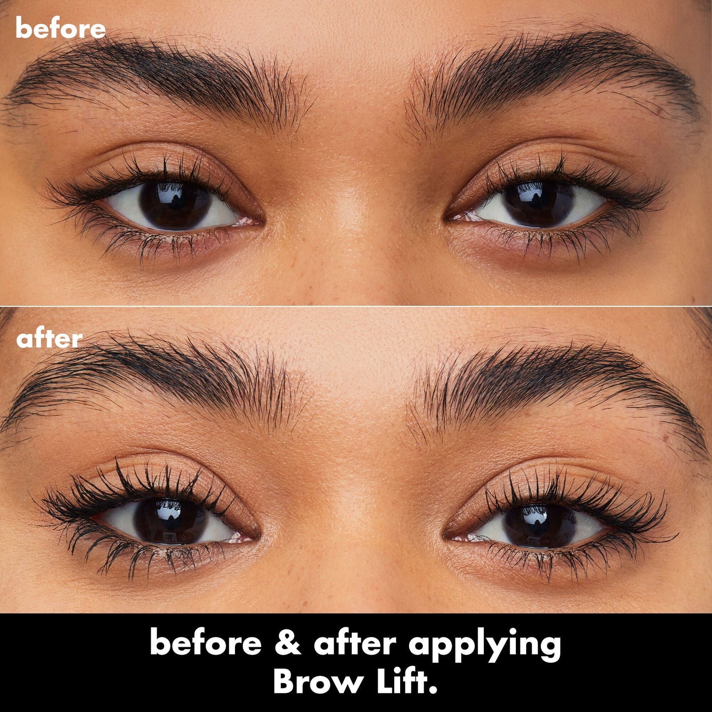 brow-lift-e3 0326_EDU_BrowLift_BA.jpg