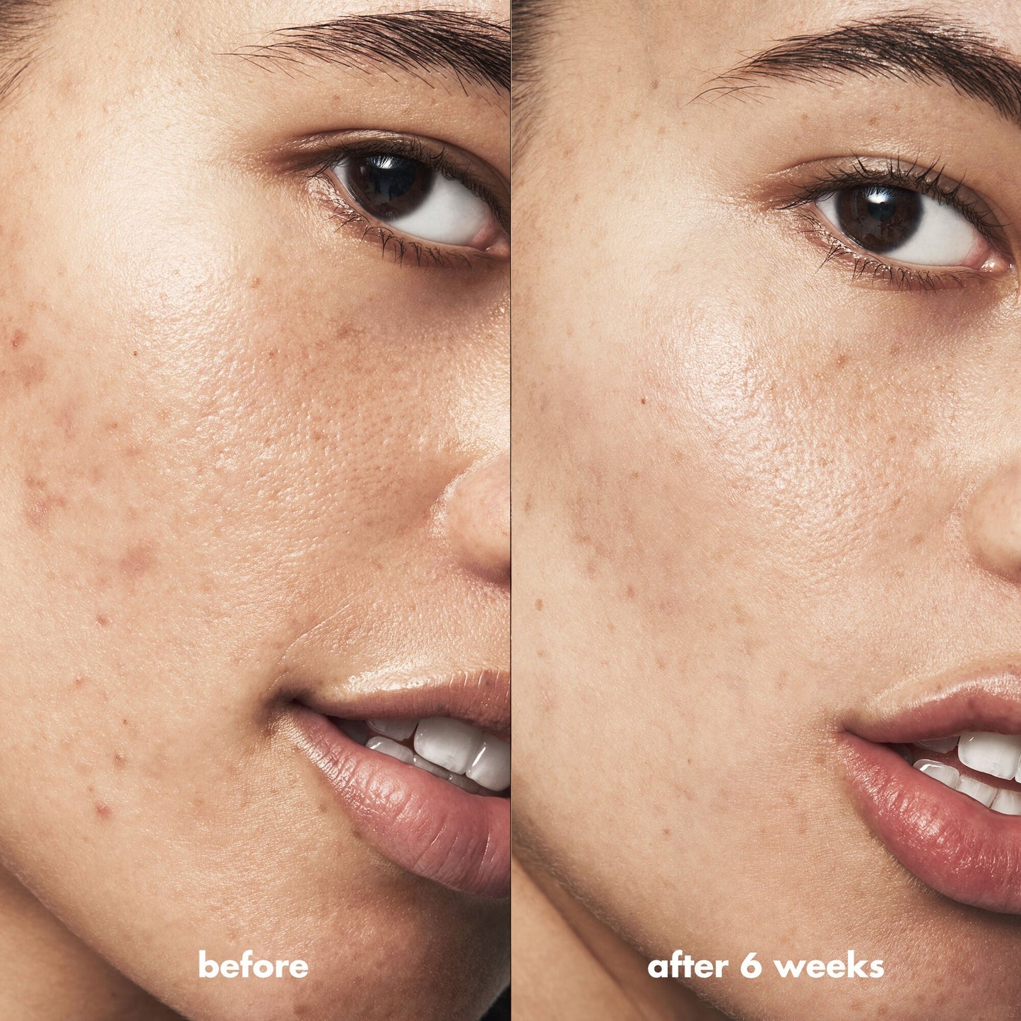 blemish-breakthrough-blemish-control-basics-kit-z5 Acne_PDP_Isabella_Before_After_0fcb9356-ae60-4e94-8953-6b1b2219dc49.jpg