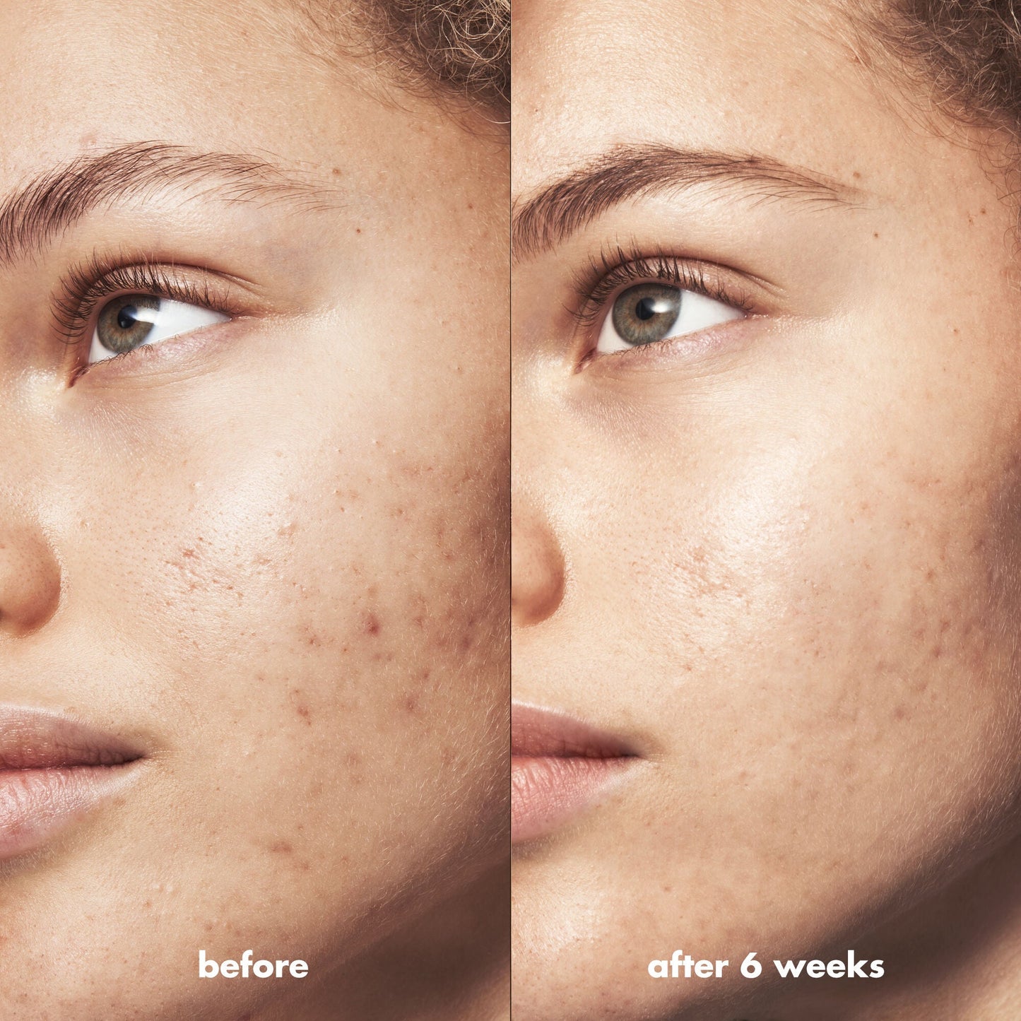 blemish-breakthrough-triple-acid-resurfacing-serum-z6 Acne_PDP_Marley_Before_After_1a95cac5-0af6-43b6-a936-d0bacbdec0bf.jpg